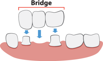 Arlington dentist, Dr. Hawkins at Crown Dentistry, shares all you need to know about dental bridges to fill the gap and restore your smile.
