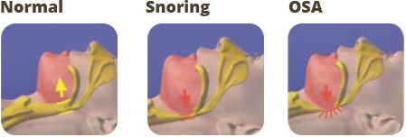 Sleep Apnea Illustration