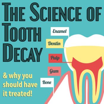 Arlington dentist, Dr. Hawkins at Crown Dentistry, discusses the science of tooth decay: what it is and what you can do to prevent it.